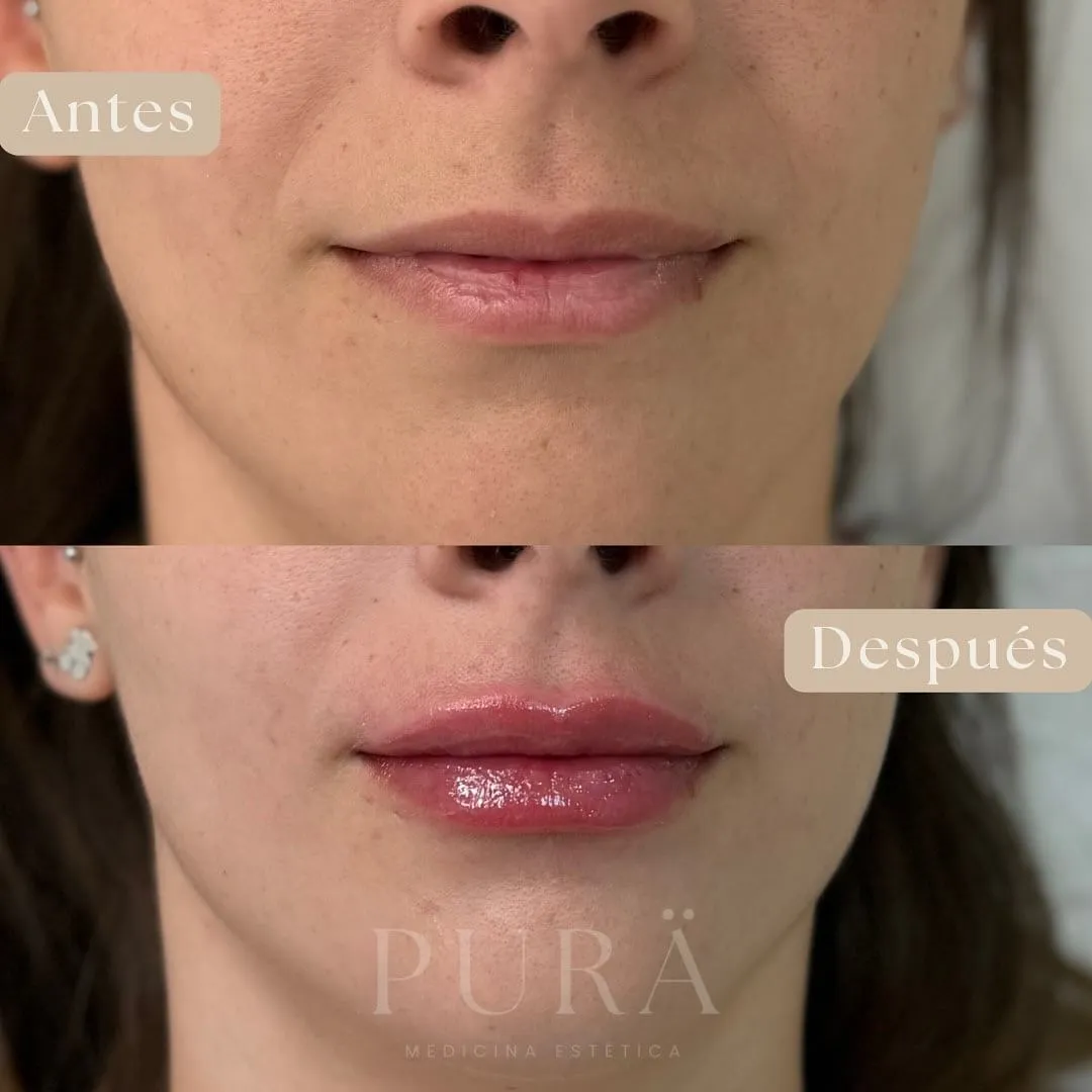 cuidados despues aumento labios con acido hialuronico