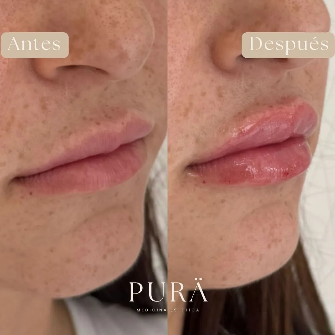 cuidados despues aumento labios con acido hialuronico